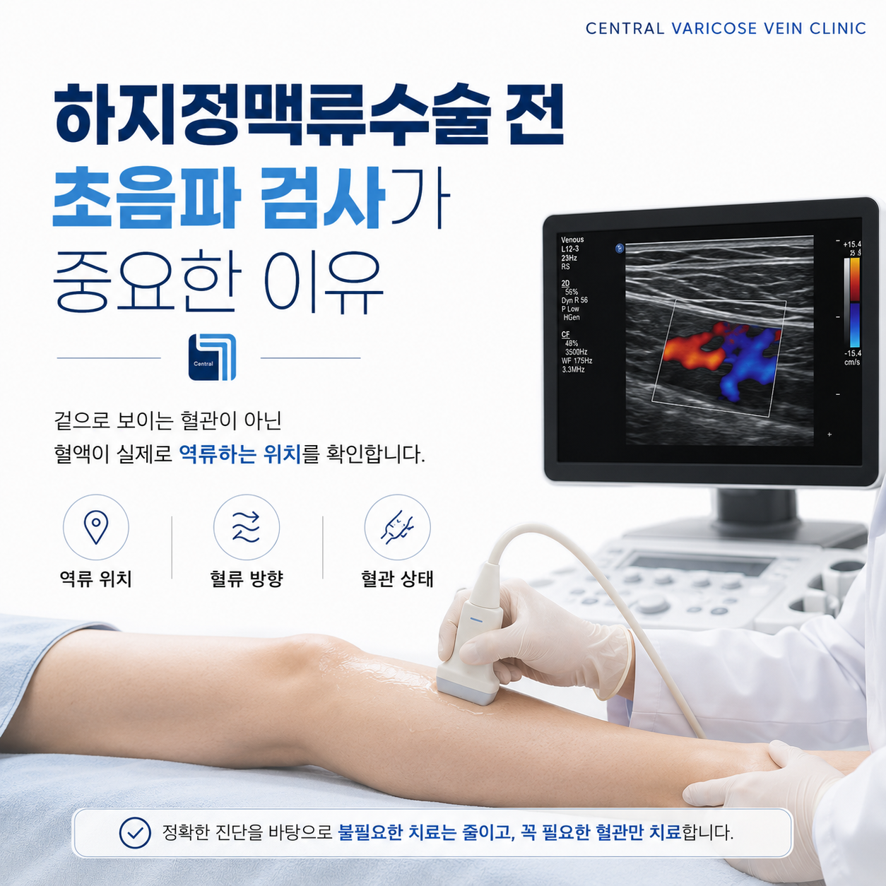 하지정맥류수술 전 초음파 검사가 중요한 이유