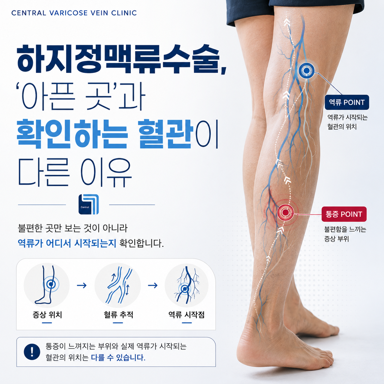 하지정맥류수술, 아픈 곳과 확인하는 혈관이 다른 이유