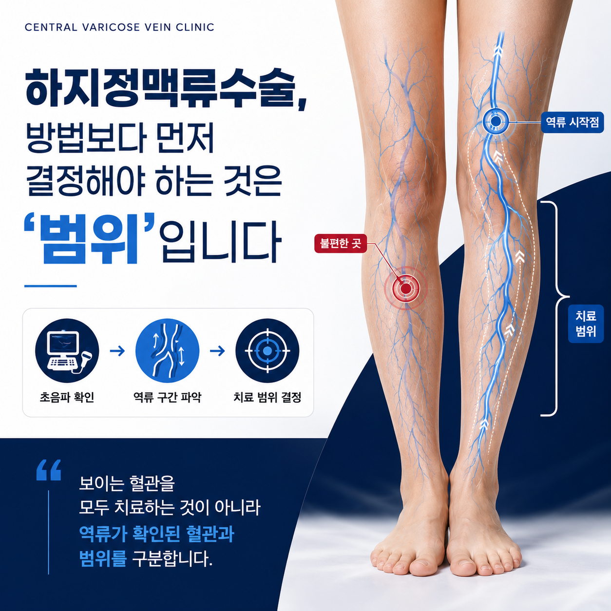 하지정맥류수술 방법보다 먼저 결정해야 하는 것은 범위예요
