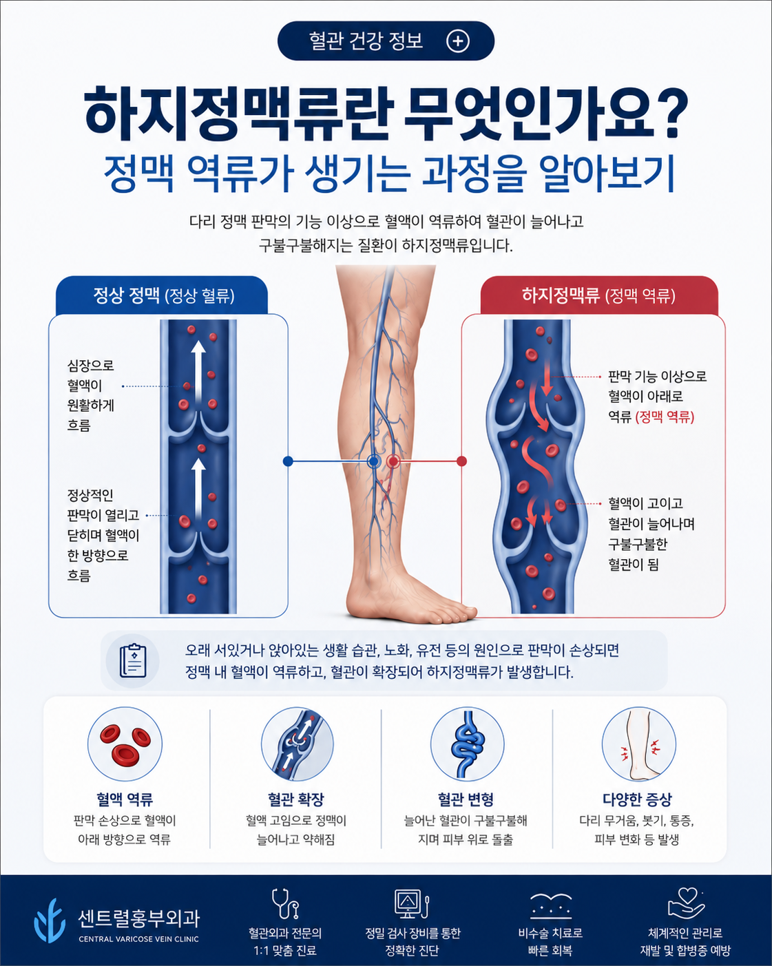 하지정맥류란 무엇인가요? 정맥 역류가 생기는 과정을 알아보기